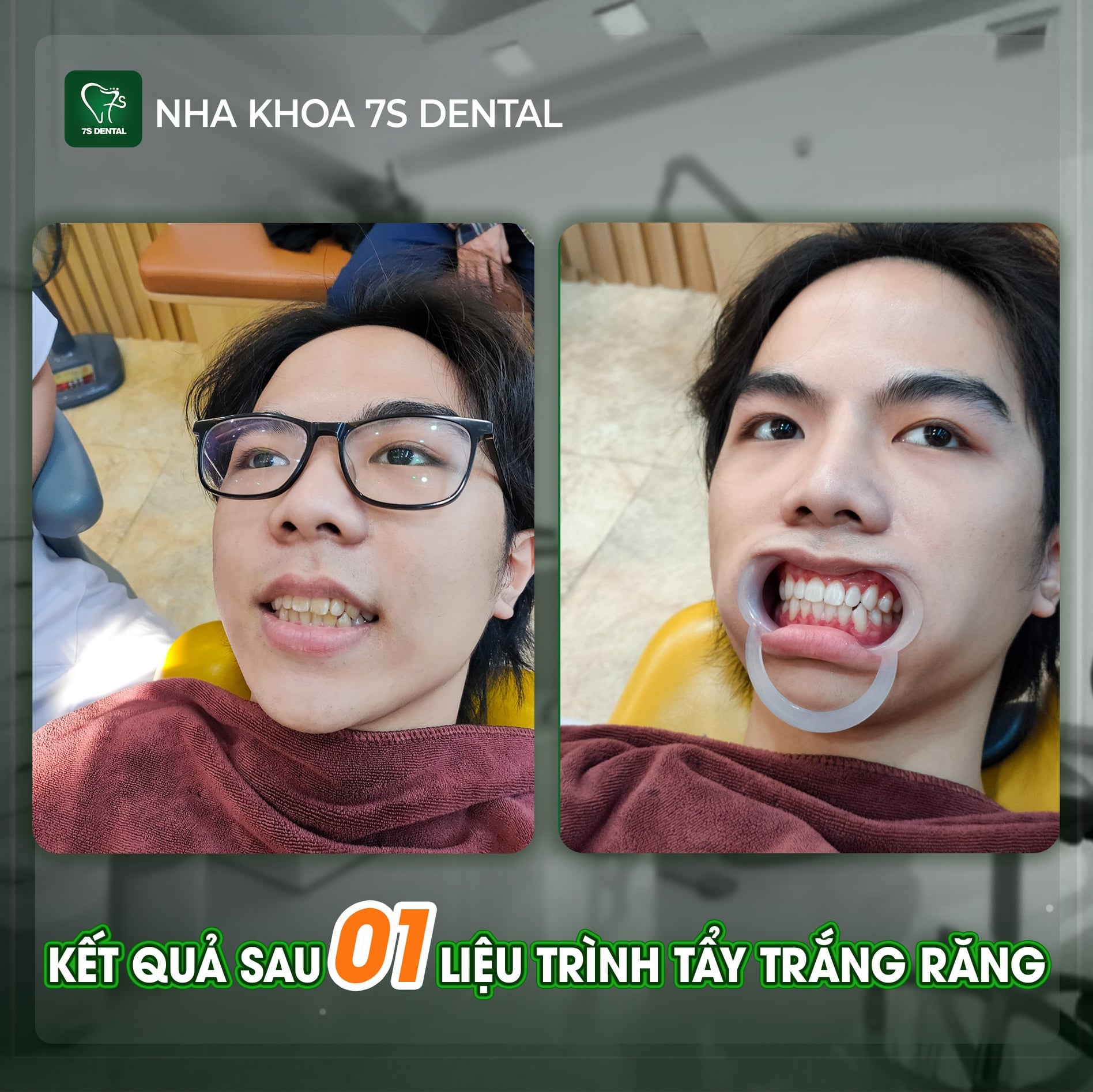 Tẩy trắng răng